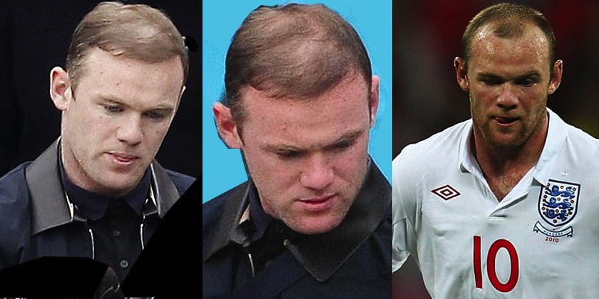 Name:  Rooney-hairtransplant-840x420.jpg
Views: 17625
Size:  95.4 KB